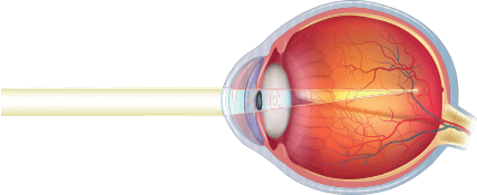 Nearsightedness or Myopia