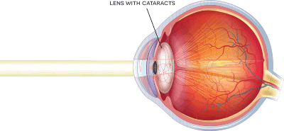 Eye with Cataracts