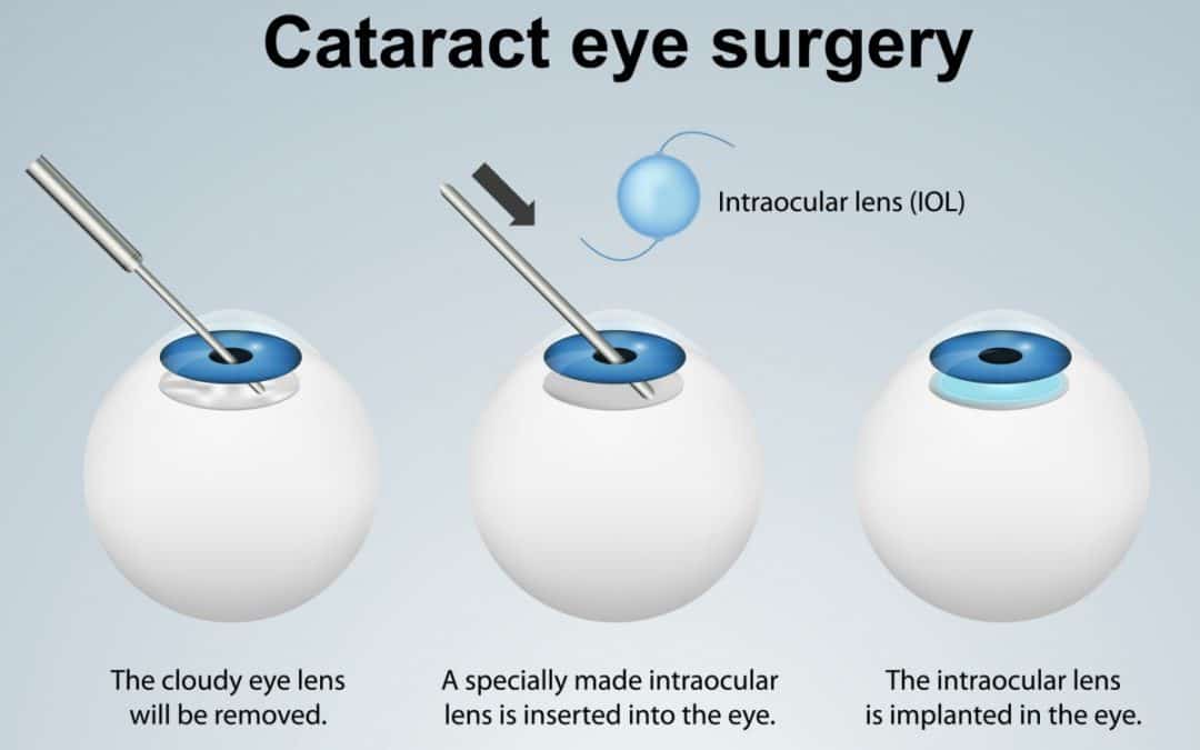 Bronx, NY top Ophthalmologist recommend Lens Implants for Cataract Surgery